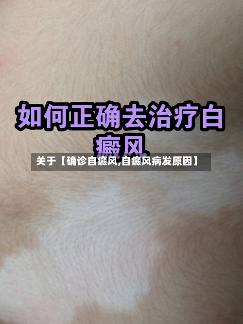 关于【确诊自癜风,自癜风病发原因】-第2张图片