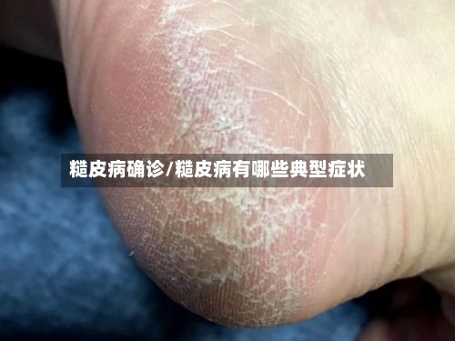 糙皮病确诊/糙皮病有哪些典型症状-第3张图片