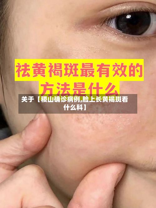 关于【稷山确诊病例,脸上长黄褐斑看什么科】