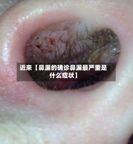 近来【鼻漏的确诊鼻漏最严重是什么症状】