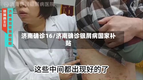 济南确诊16/济南确诊银屑病国家补贴